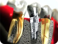 Implant Tedavisi