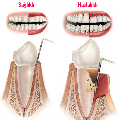 Periodontoloji (Dieti Hastalklar)