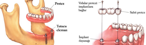 Protetik Di Tedavisi